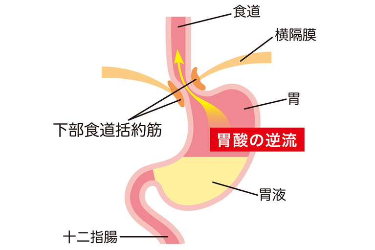 逆流性食道炎とは