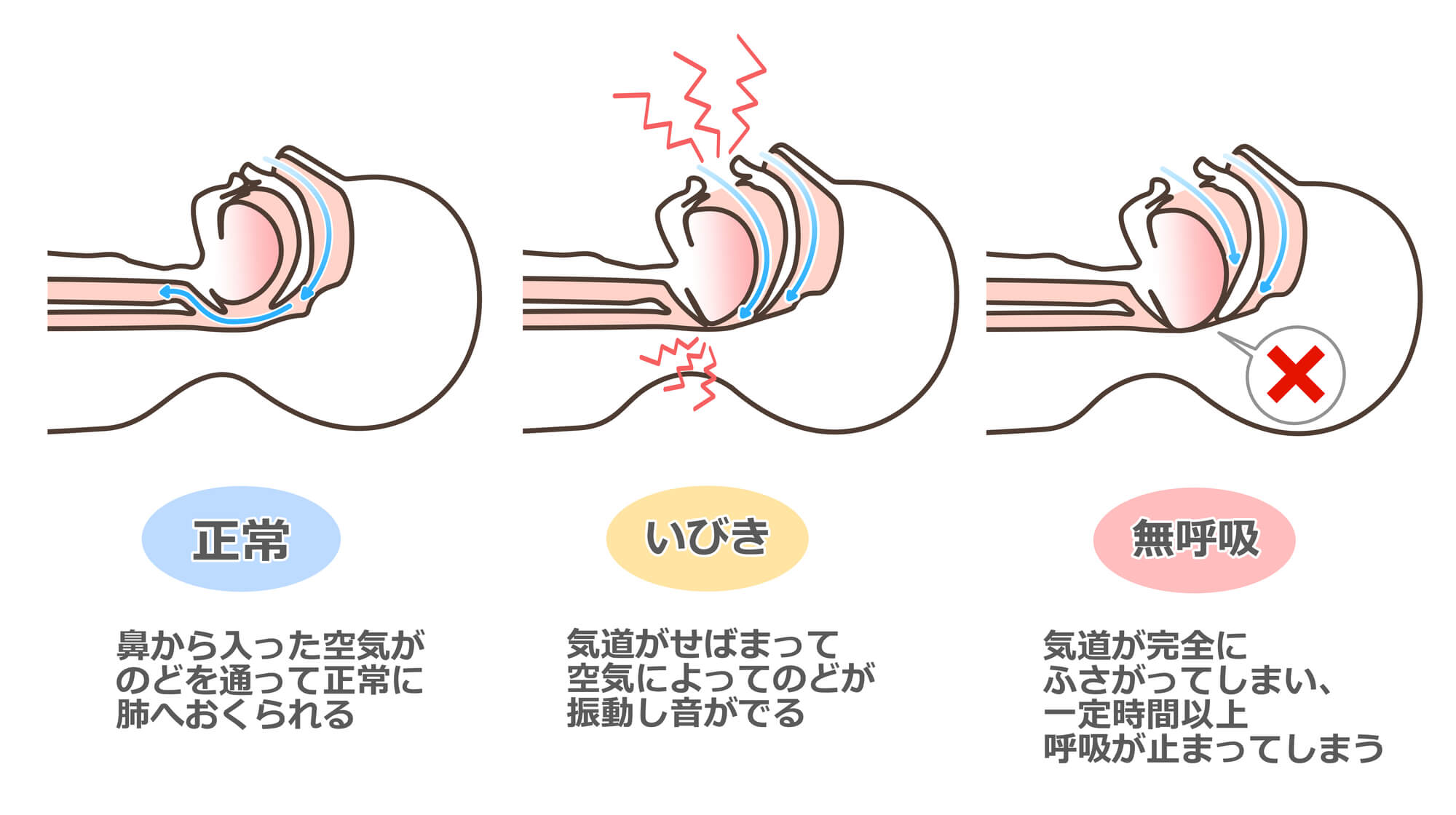 睡眠時無呼吸症候群（SAS）になる原因